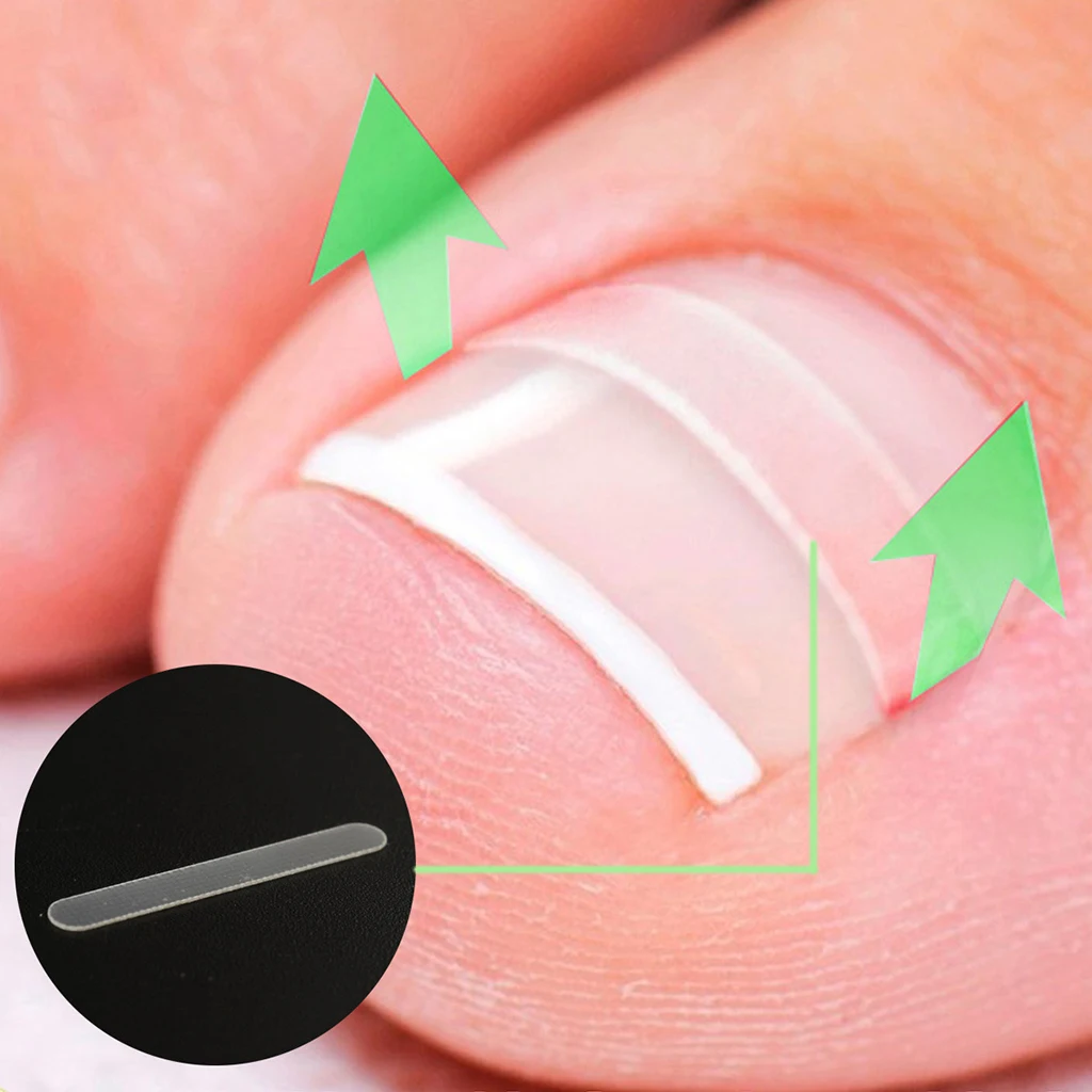 Врастнал нокът изправяне клип прозрачен еластичен пластир стикер пръсти нокти грижи коректор кръпка скоба педикюр