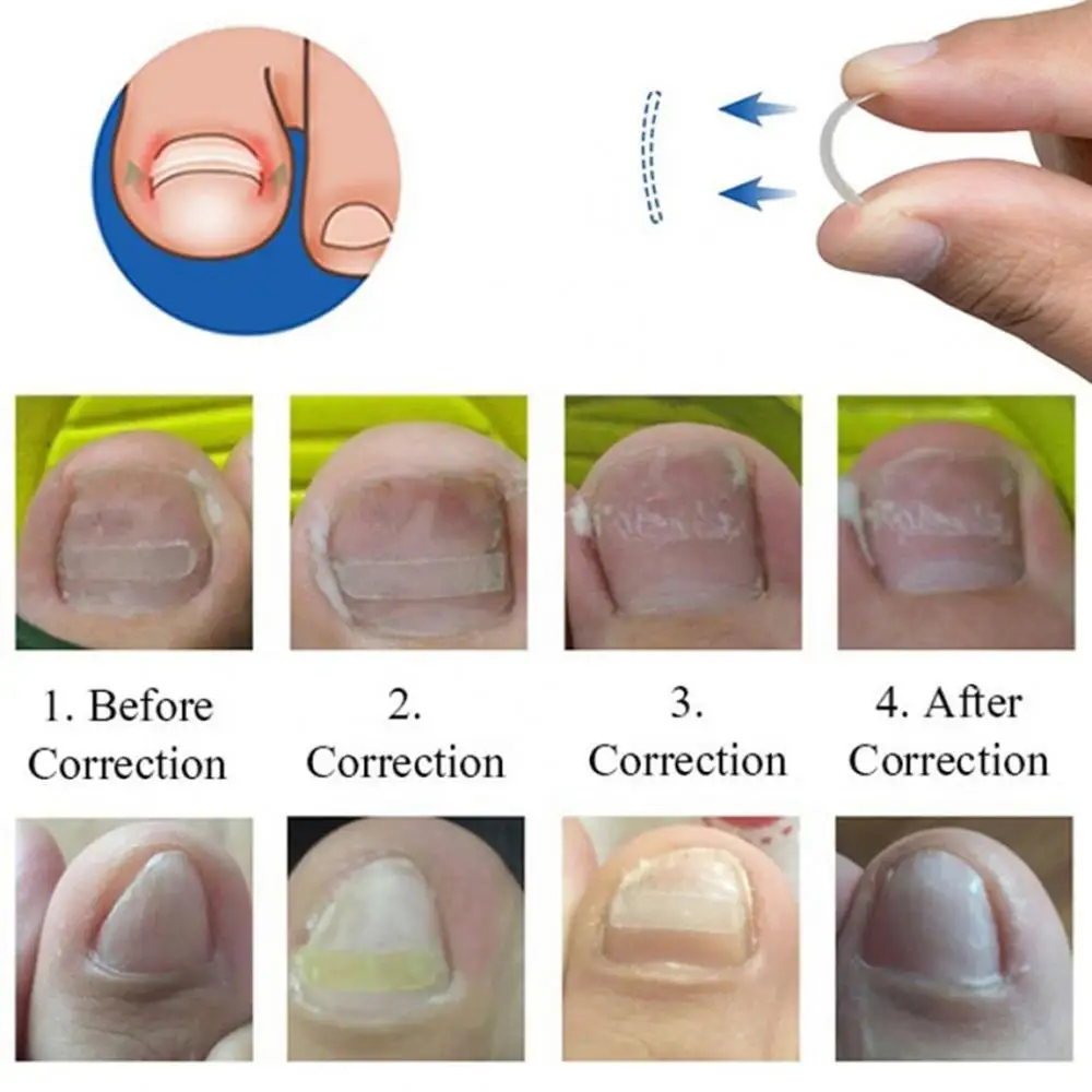 Врастнал нокът изправяне клип прозрачен еластичен пластир стикер пръсти нокти грижи коректор кръпка скоба педикюр